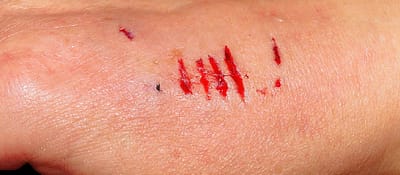 Hand with wound